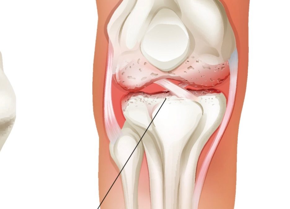 Knee Osteoarthritis: Myth Busting and Current Approaches